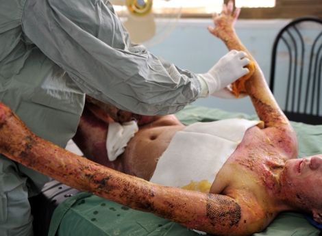 Source: http://www.lynseyaddario.com/healthcare-maternal-mortality-and-sexual-violence/afghanistan-self-immoliation/03_LA_Burned