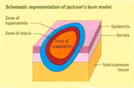 jacksons-burn-wound-model